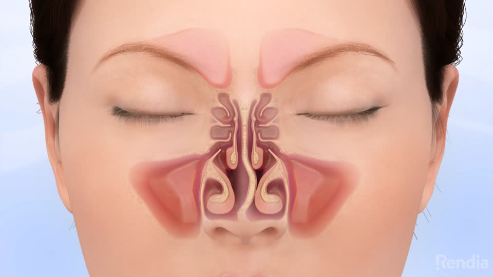 Post Nasal Drip and Deviated Septums